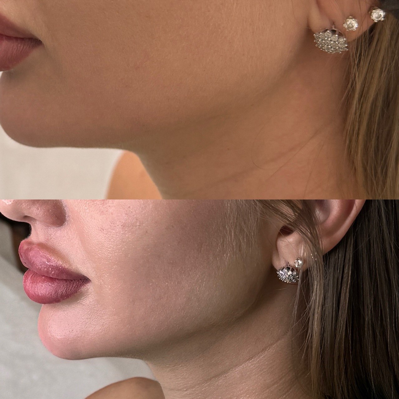 Коррекция уголков рта