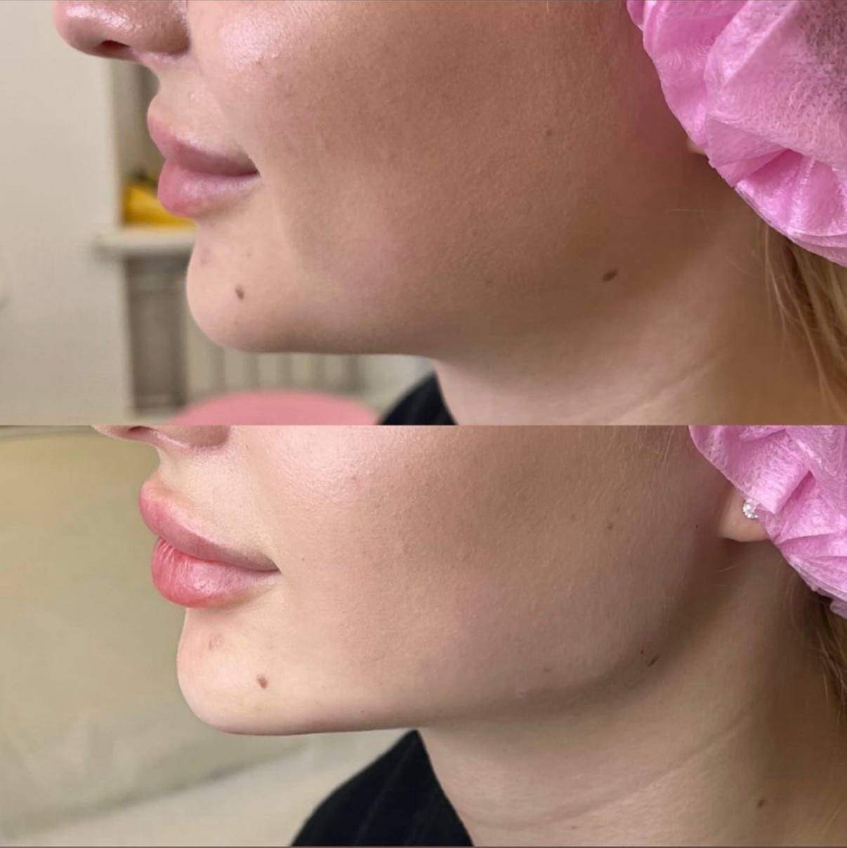 Коррекция уголков рта